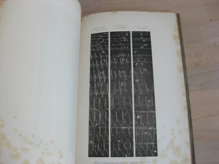 De la spartéine en thérapeutique cardiaque - Dr. Henry Bulteau De la spartéine en thérapeutique cardiaque - Dr. Henry Bulteau